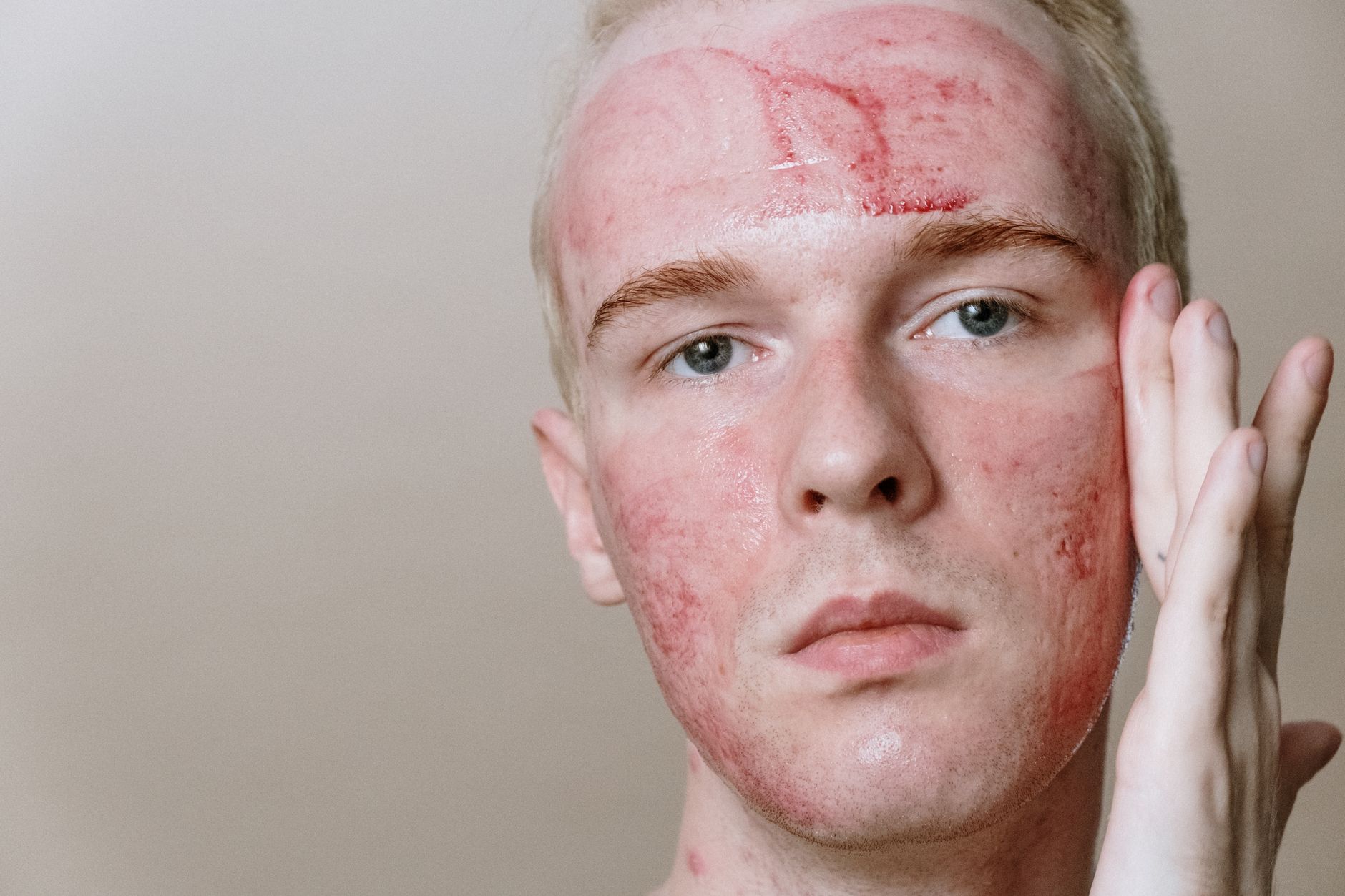#9 — Sudden Acne Flares From High-Protein Diets