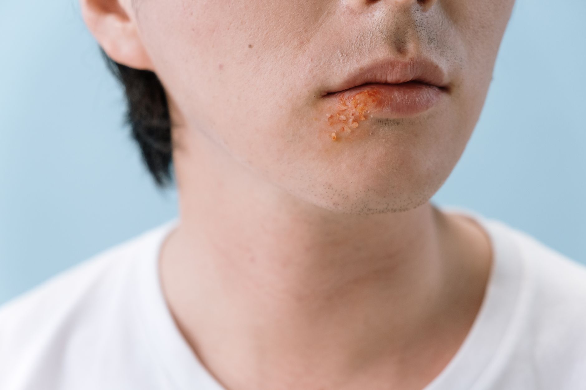 #4 — Cracked Lip Corners From B-Vitamin Gaps