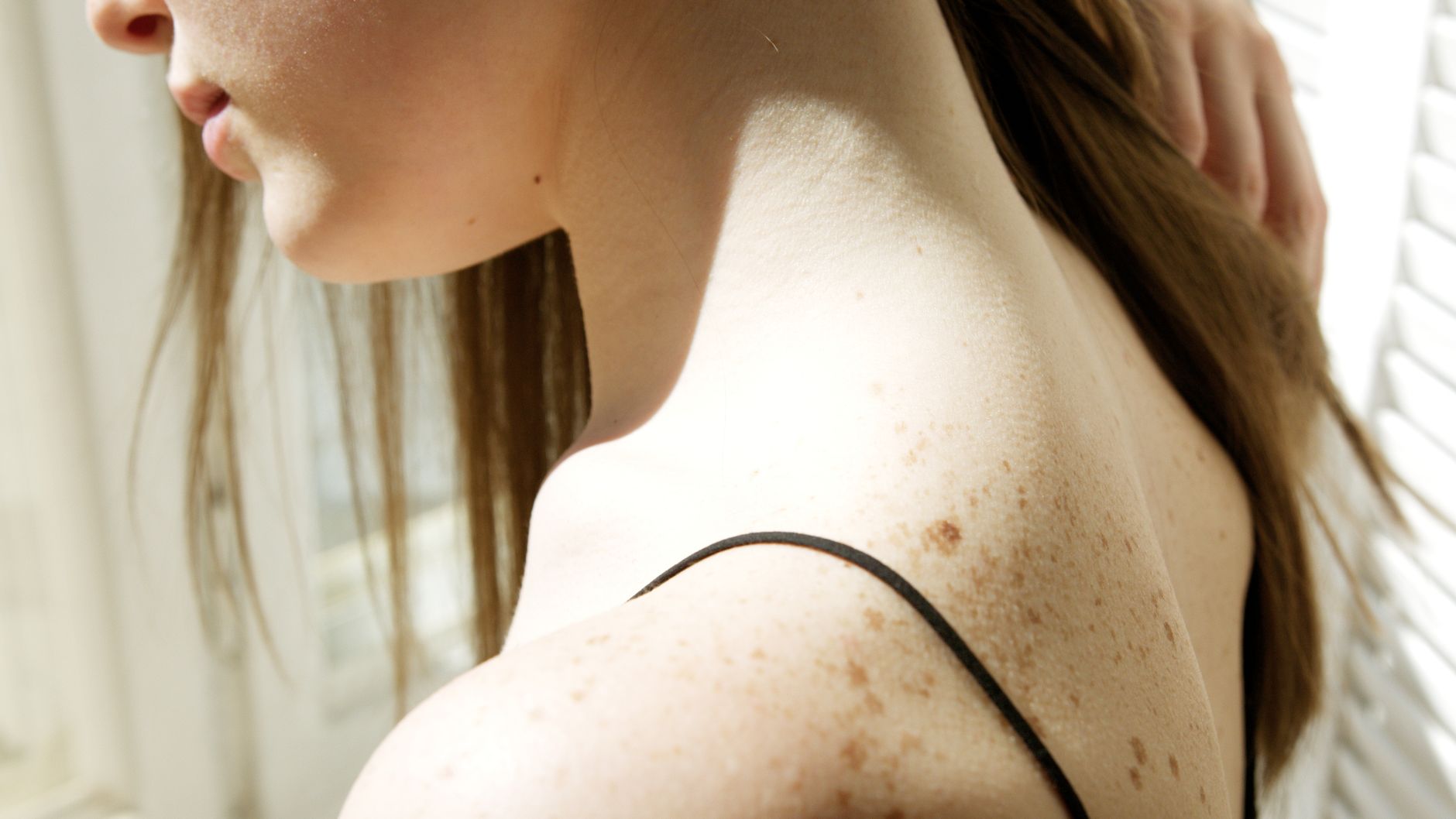 #5 — Skin Tags Multiplying on High-Sugar Diets