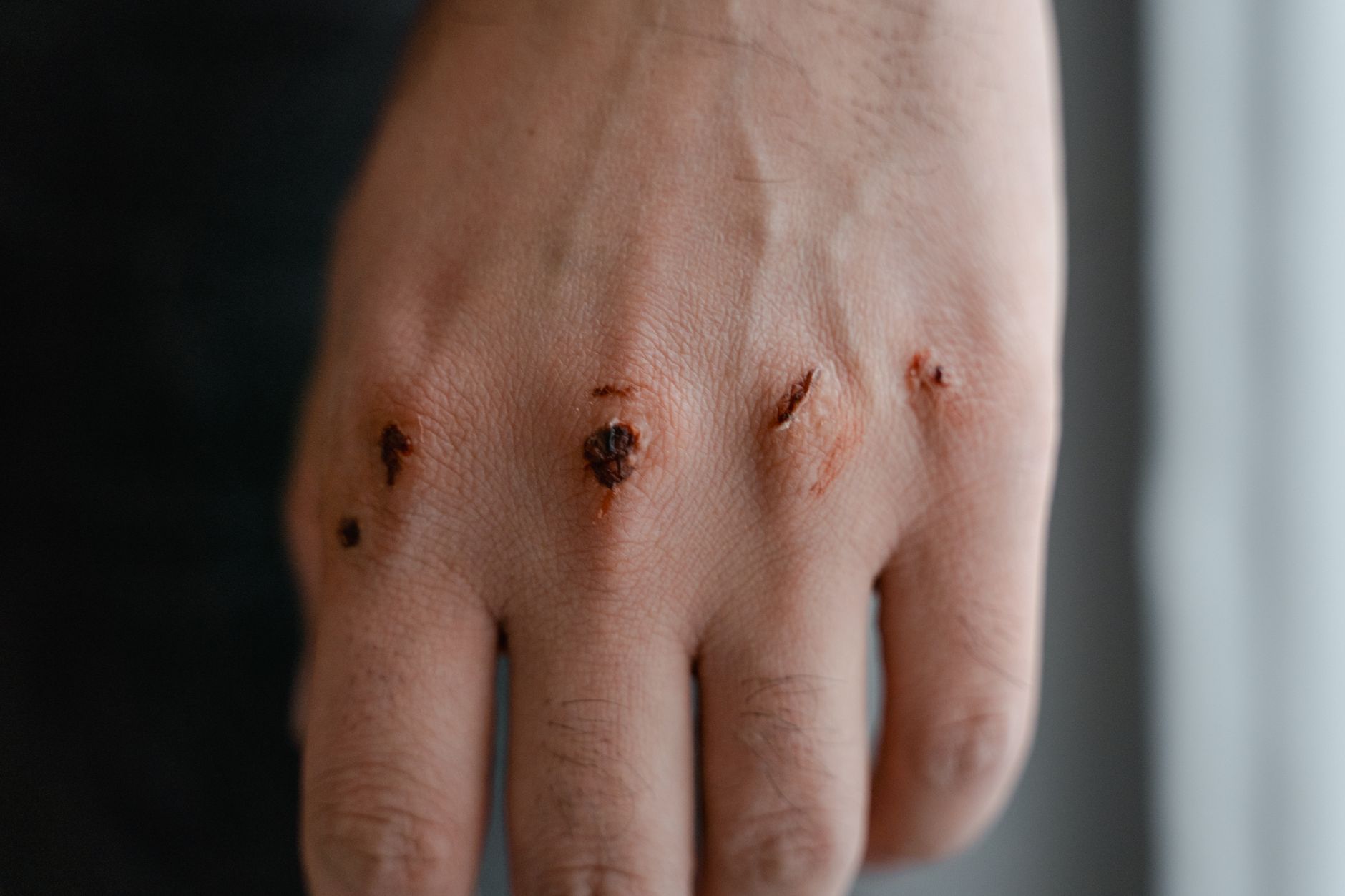 #2 — Slow Wound Healing on Prolonged Low-Protein Diets